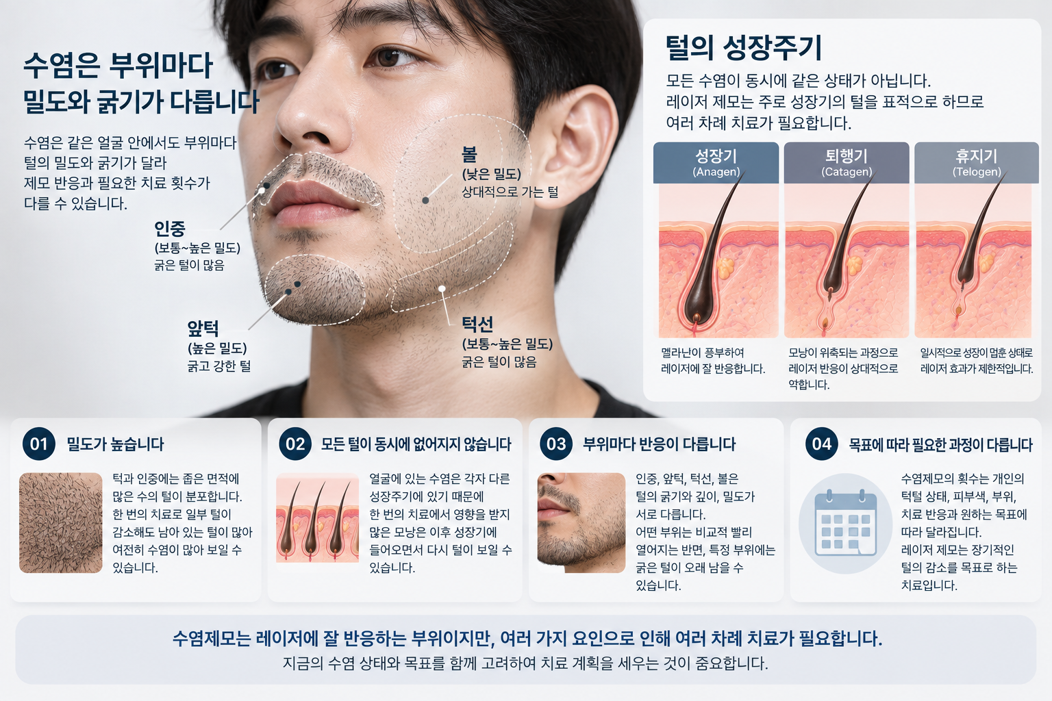 남성 얼굴의 인중, 턱, 턱선과 볼에서 수염의 밀도와 성장주기가 달라 레이저 제모에 여러 차례 치료가 필요한 이유를 설명한 이미지