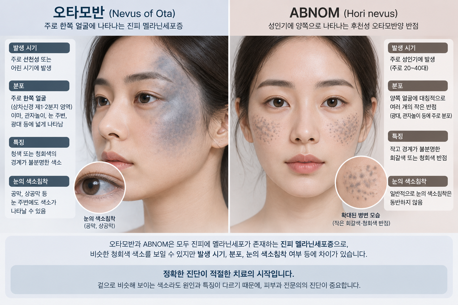 오타모반의 한쪽 얼굴과 눈 주변 청회색 색소 분포와 ABNOM의 양쪽 광대 회갈색 반점 분포를 비교한 이미지