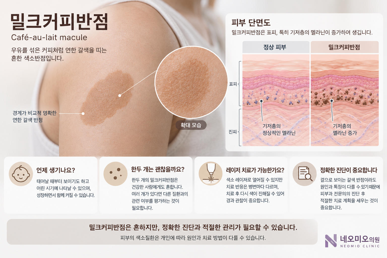 밀크커피반점의 균일한 연갈색 피부 병변과 표피 기저층에서 멜라닌이 증가한 모습을 설명한 이미지