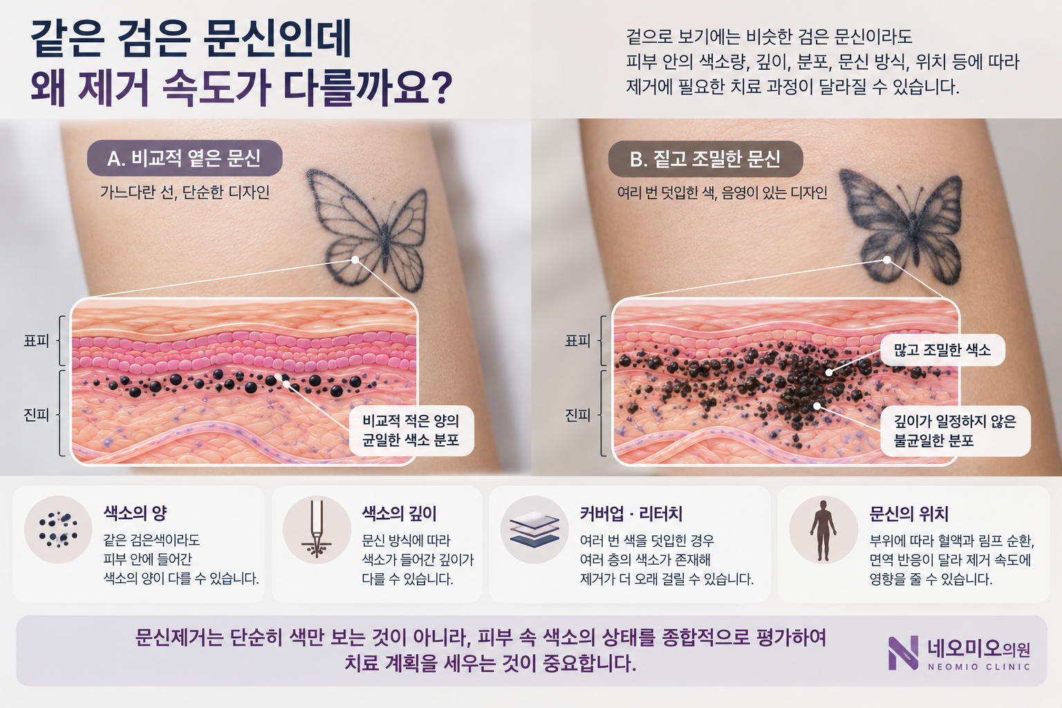 겉으로 비슷한 검은 문신이라도 피부 속 문신 안료의 양과 깊이, 분포가 달라 제거 속도에 차이가 생길 수 있음을 비교한 이미지