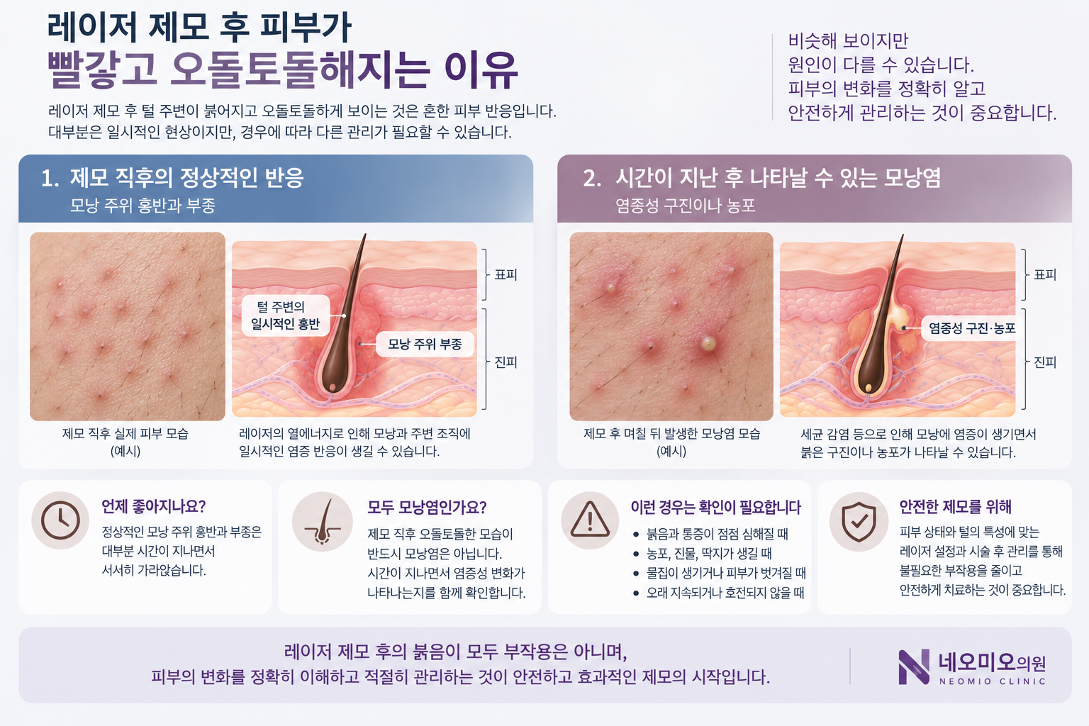 레이저 제모 직후 나타나는 정상적인 모낭 주위 홍반과 부종을 제모 후 모낭염과 비교한 이미지