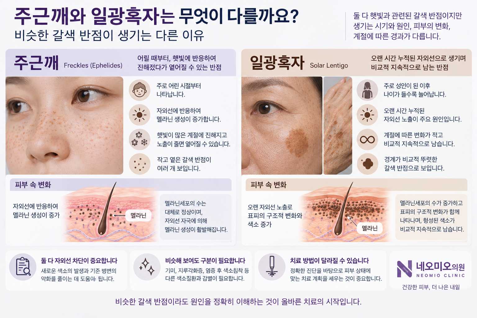 주근깨와 일광흑자의 발생 시기, 자외선과의 관계, 계절 변화와 지속성의 차이를 비교한 이미지