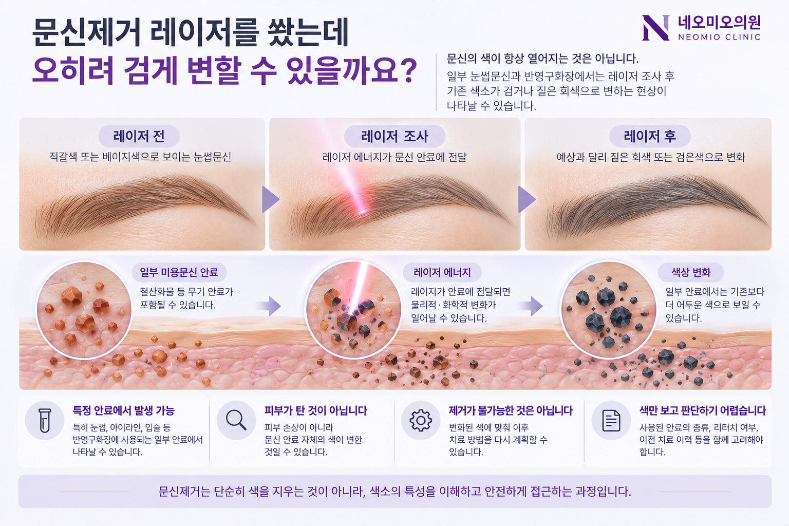 일부 눈썹문신과 반영구화장 안료가 레이저 조사 후 짙은 회색이나 검은색으로 변하는 역설적 흑변 현상을 설명한 이미지