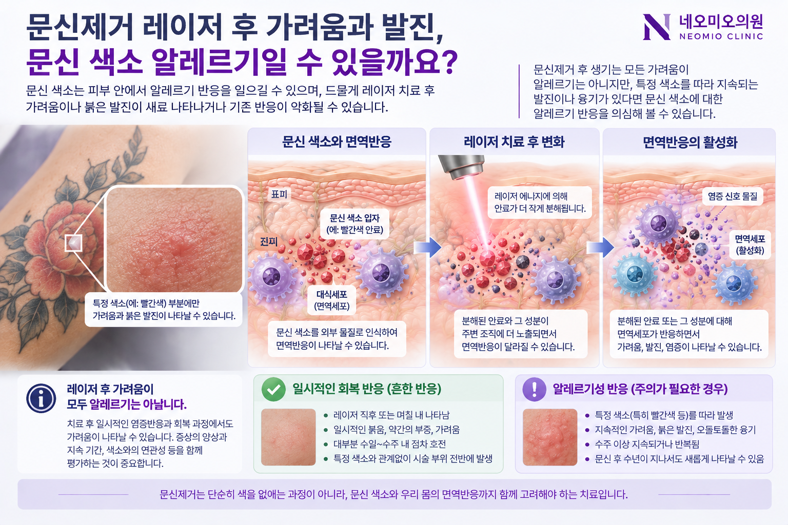 문신의 특정 색소에서 알레르기성 피부반응이 나타나고 레이저 문신제거 후 분해된 안료와 면역계의 상호작용이 달라질 수 있는 과정을 설명한 이미지