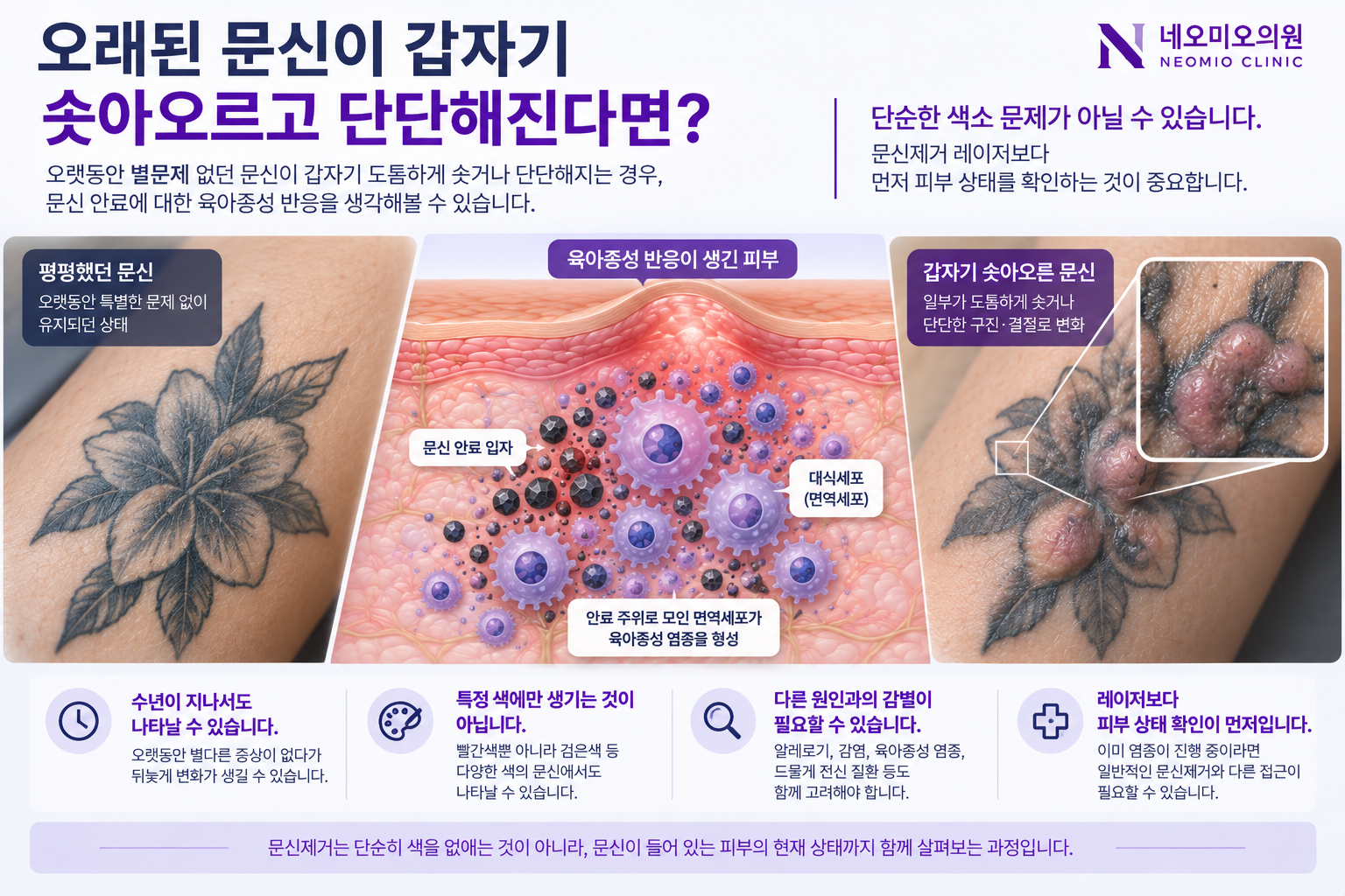 래된 문신 부위가 갑자기 솟아오르거나 단단해지는 육아종성 반응과 문신 안료 주변에 면역세포가 모이는 과정을 설명한 이미지