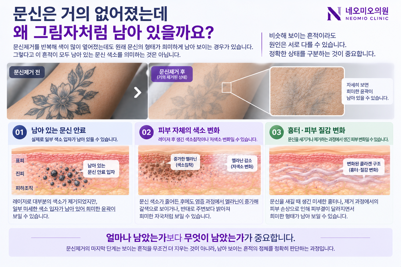 문신제거 후 희미하게 남은 흔적이 잔존 문신 안료, 피부 색소 변화, 흉터와 피부 질감 변화로 서로 다를 수 있음을 설명한 이미지