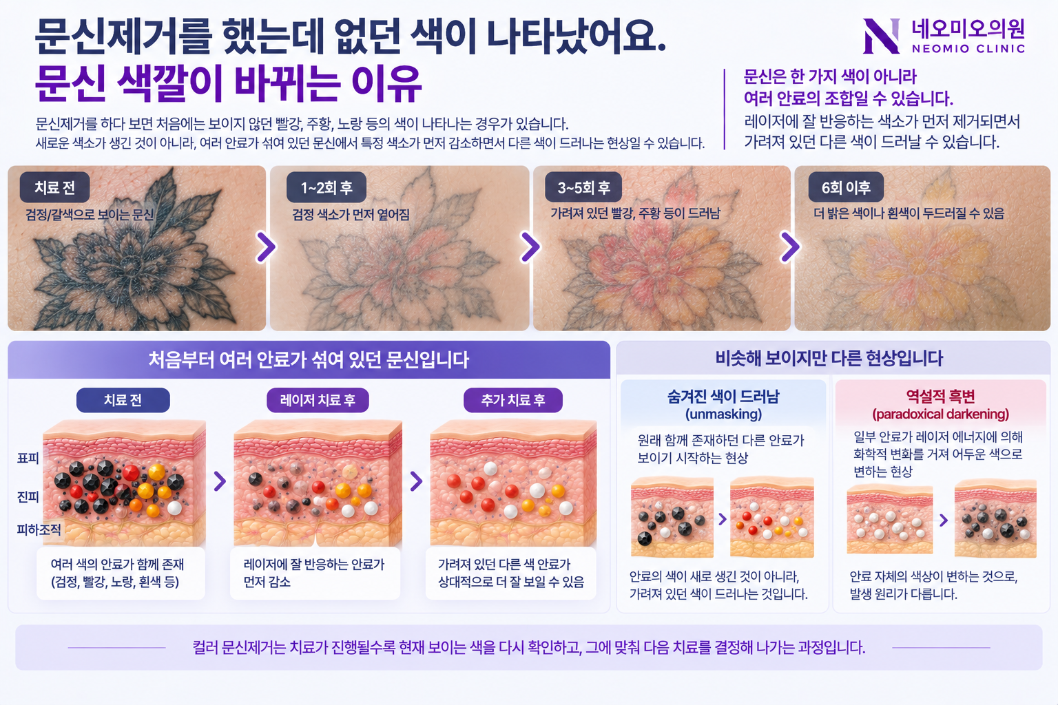컬러 문신과 반영구화장 제거 과정에서 한 색소가 먼저 감소하면서 기존에 혼합되어 있던 빨강, 주황, 노랑, 흰색 등의 다른 안료가 드러나는 현상을 설명한 이미지
