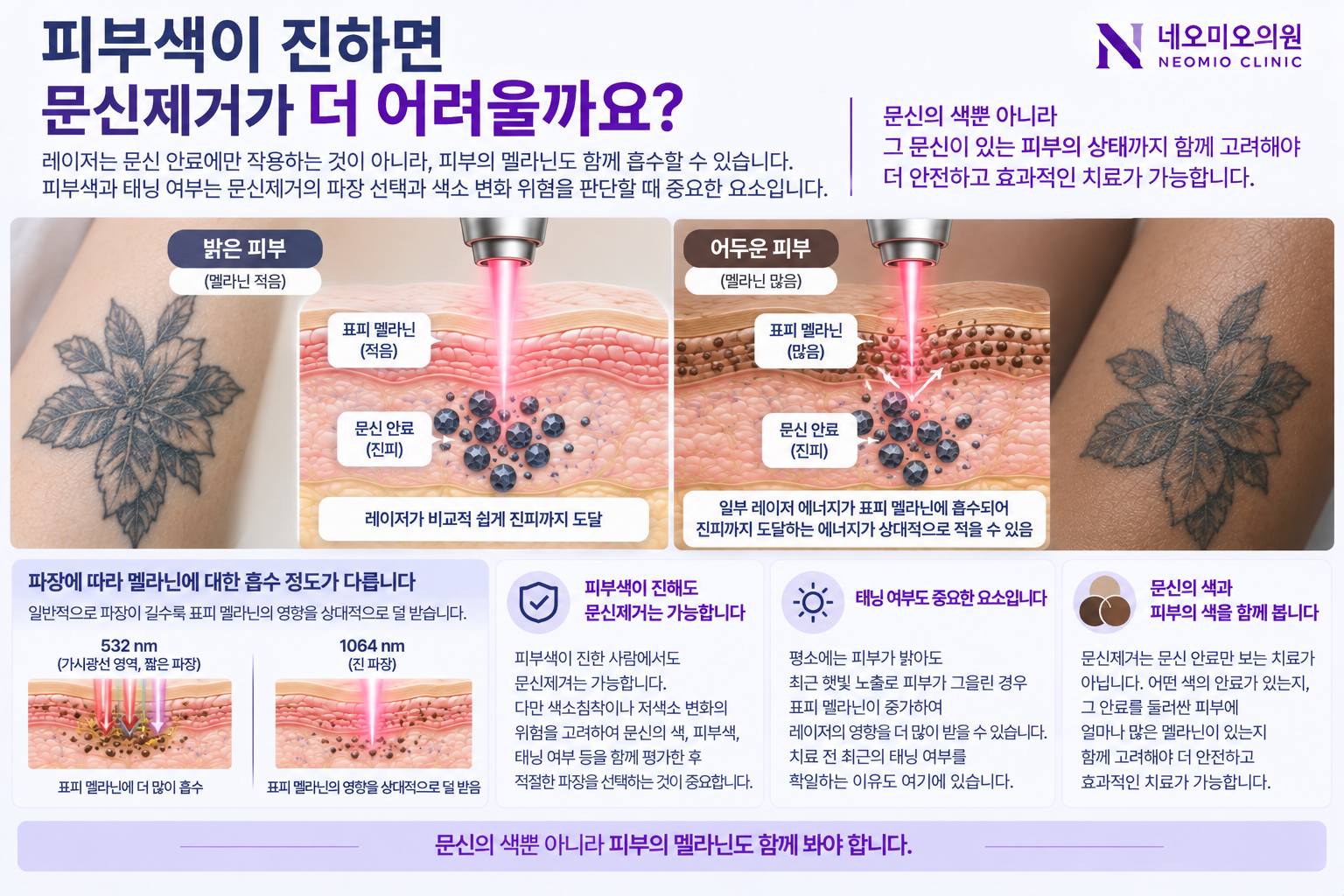 밝은 피부와 멜라닌이 많은 피부에서 문신제거 레이저가 표피를 통과해 문신 안료에 도달하는 차이를 설명한 이미지