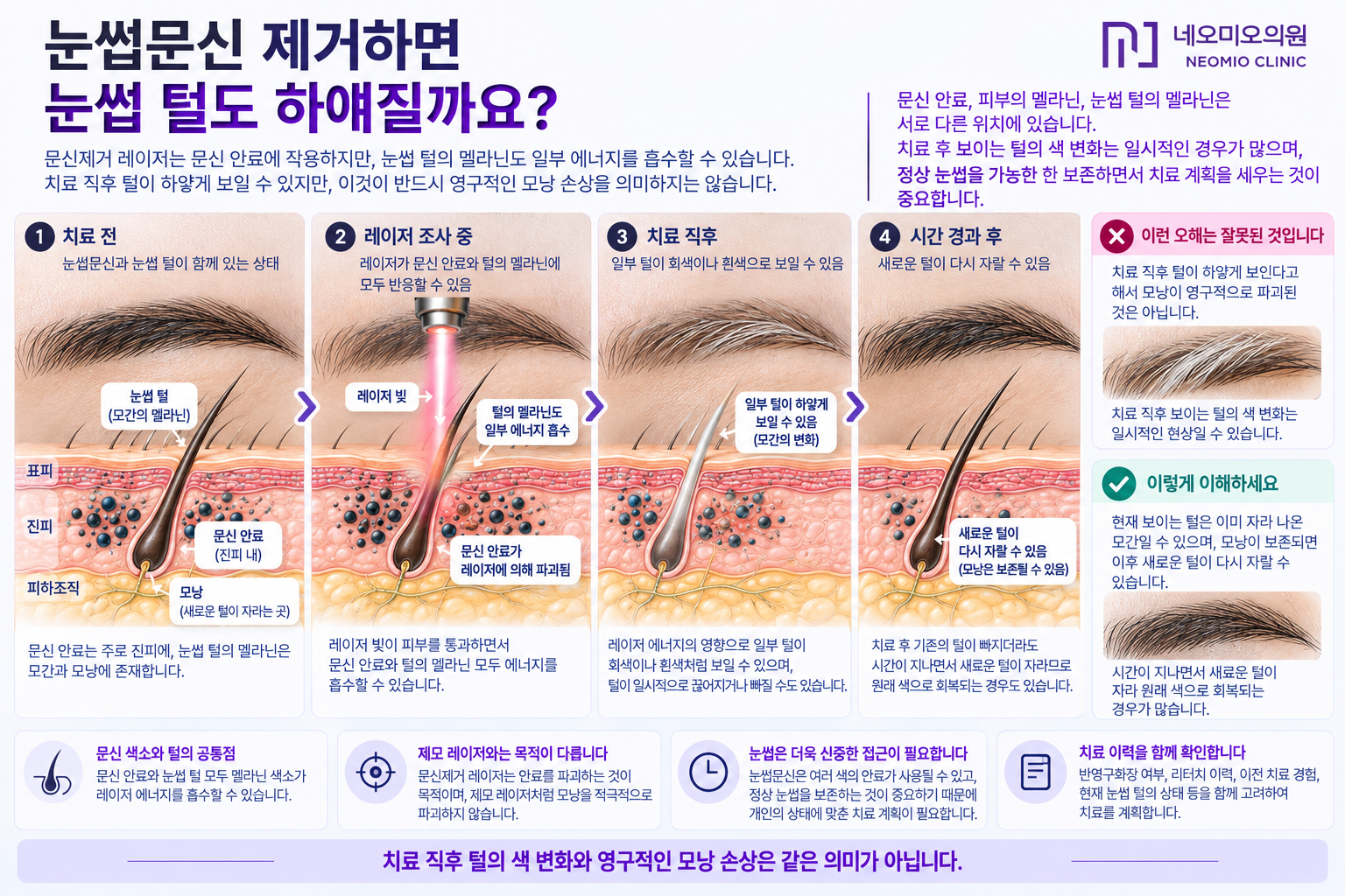 눈썹문신 제거 레이저 후 기존 눈썹 털이 일시적으로 희게 보일 수 있으며 모발의 색 변화와 영구적인 모낭 손상은 구분해야 함을 설명한 이미지