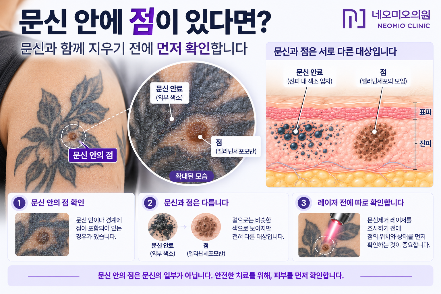 문신 안에 있는 점을 문신 안료와 구분하고 문신제거 레이저 치료 전에 점을 먼저 확인해야 하는 이유를 설명한 이미지