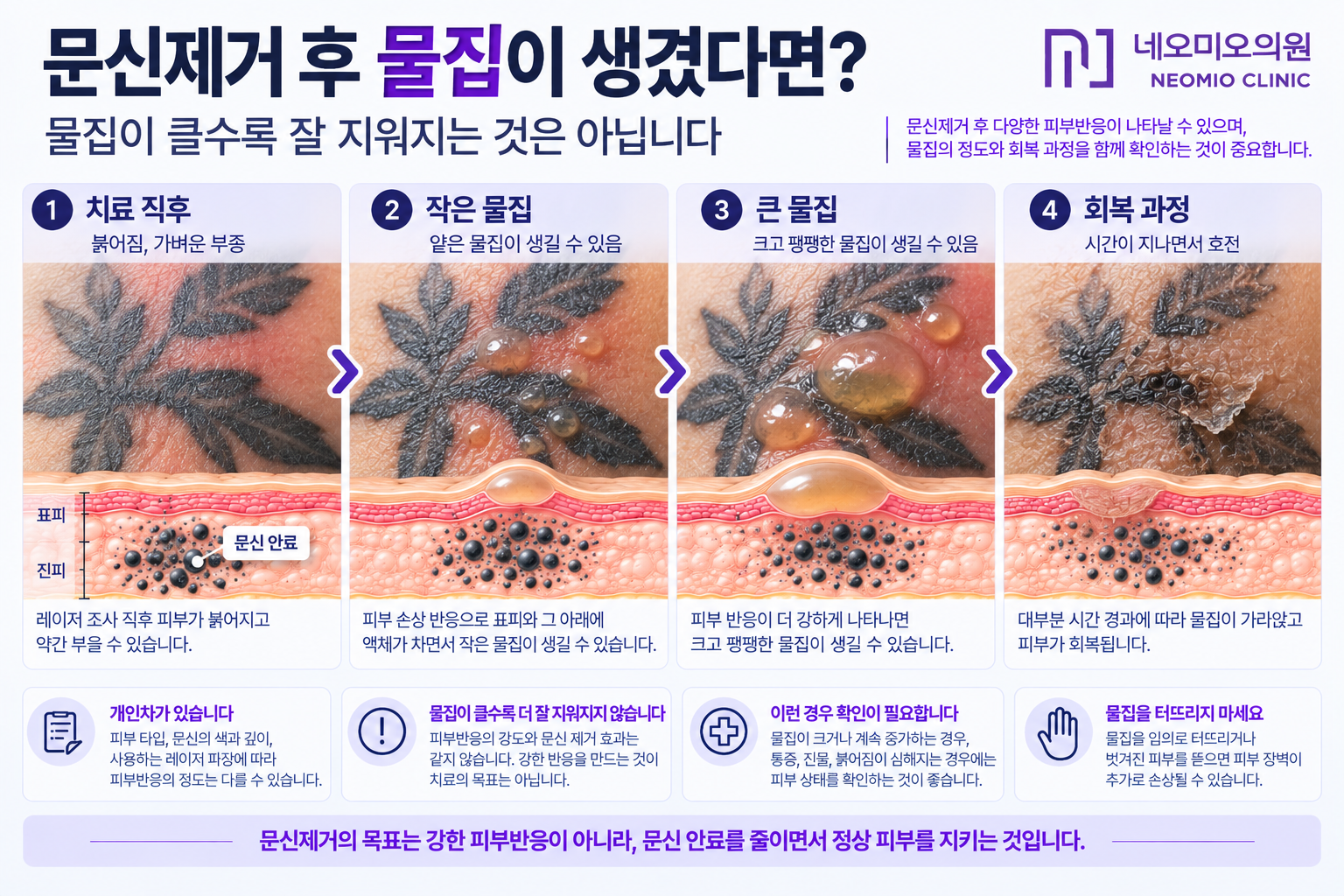문신제거 레이저 후 붉어짐과 부종부터 물집까지 나타날 수 있는 피부반응과 물집의 정도 및 회복 과정을 확인해야 하는 이유를 설명한 이미지