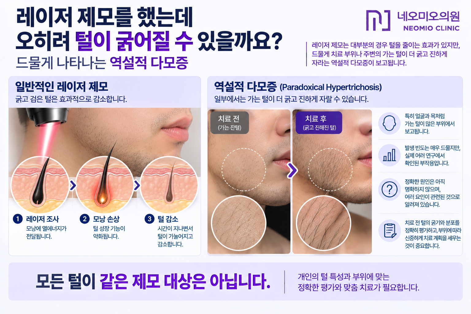 레이저 제모 후 드물게 가는 털이 더 굵고 진하게 보일 수 있는 역설적 다모증과 얼굴 및 목의 잔털 치료에서 주의가 필요한 이유를 설명한 이미지
