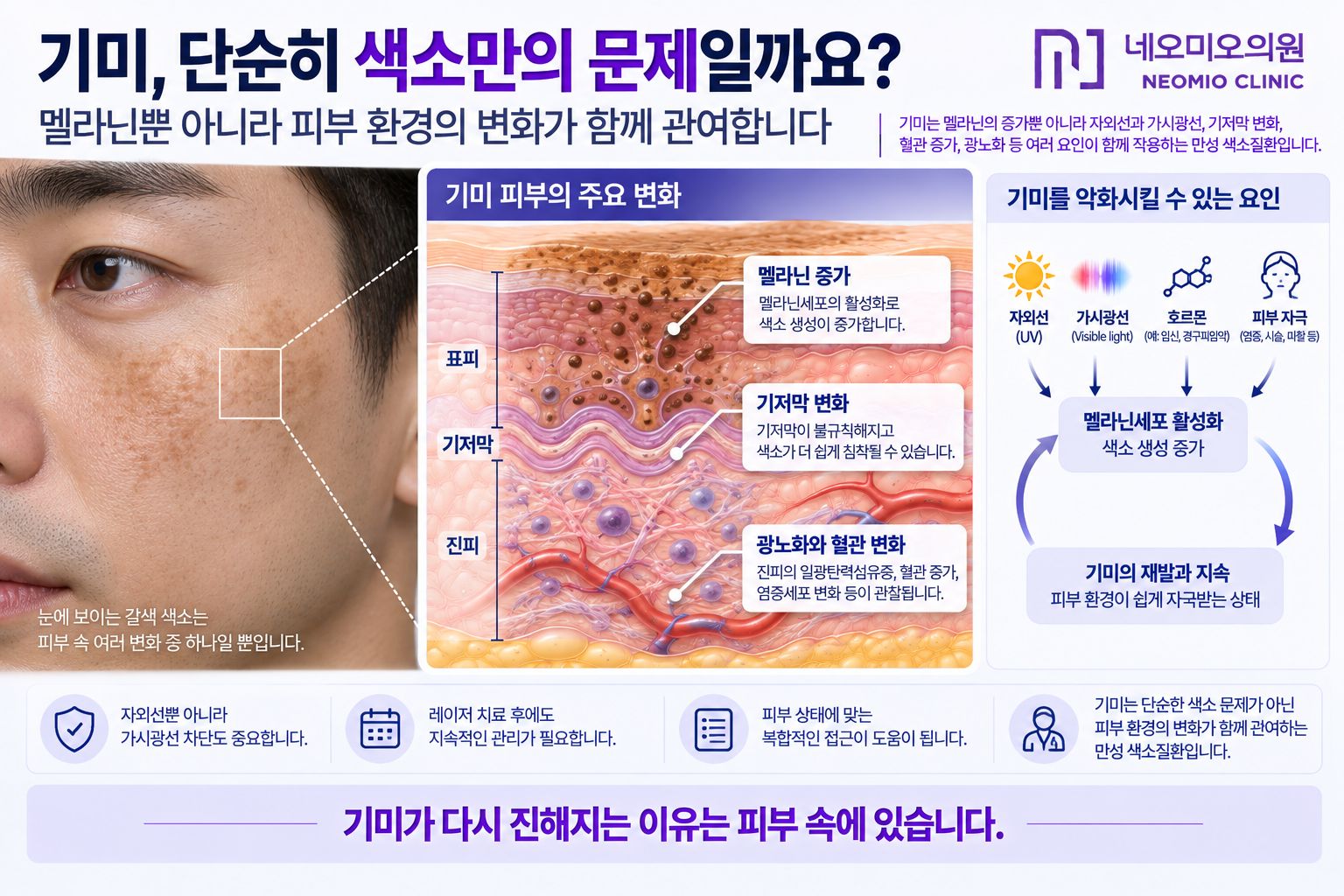 기미 피부에서 멜라닌 증가뿐 아니라 기저막 변화와 진피 광노화 및 혈관 변화가 함께 나타나 기미가 반복될 수 있는 이유를 설명한 이미지
