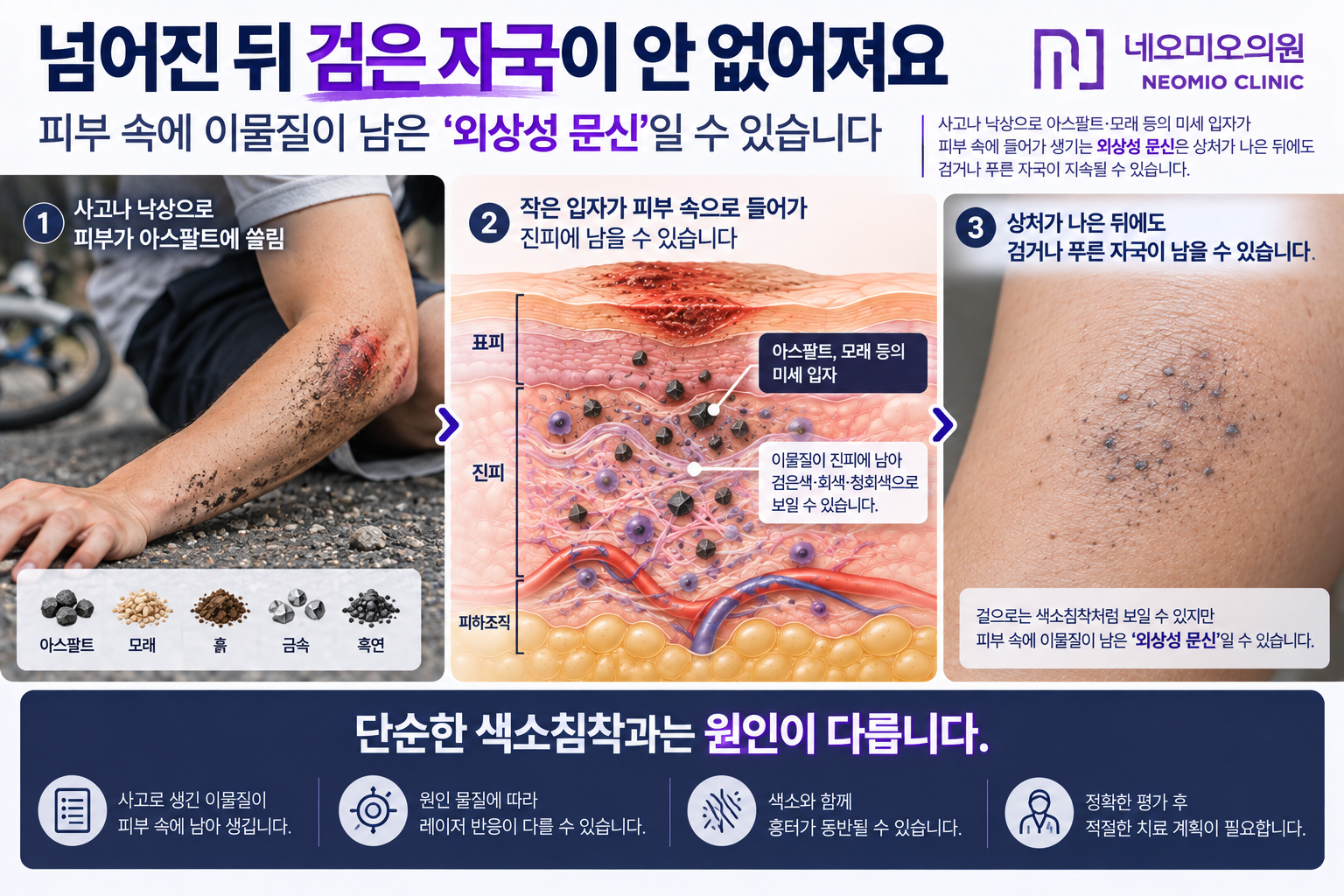 낙상이나 교통사고 때 아스팔트와 모래 같은 이물질이 피부 진피에 박혀 상처가 회복된 뒤에도 검거나 청회색 자국으로 남는 외상성 문신을 설명한 이미지