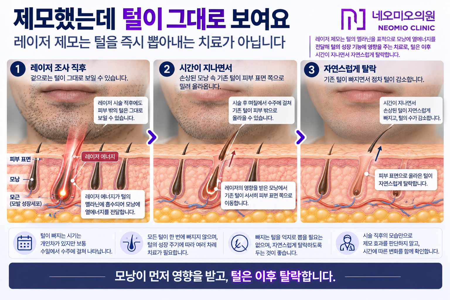 레이저 제모 직후 털이 남아 있더라도 모낭이 먼저 레이저의 영향을 받은 뒤 기존 털이 시간이 지나면서 피부 밖으로 탈락하는 과정을 설명한 이미지