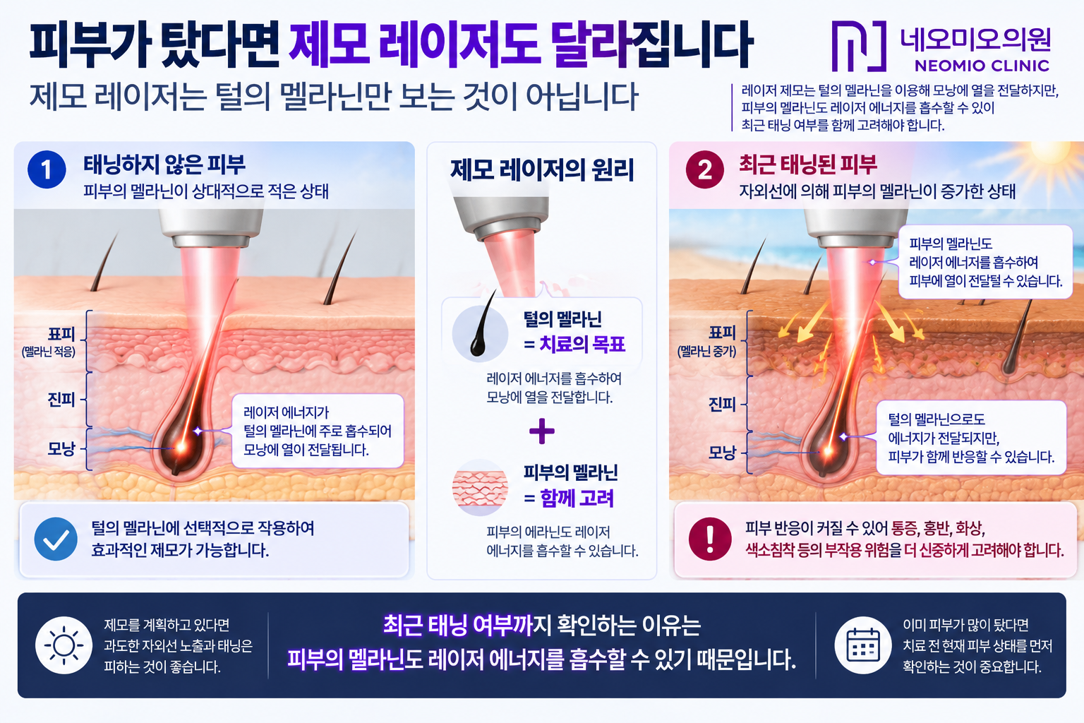 레이저 제모에서 털의 멜라닌뿐 아니라 피부 표피의 멜라닌도 레이저 에너지를 흡수하기 때문에 최근 태닝된 피부의 상태를 확인해야 하는 이유를 설명한 이미지