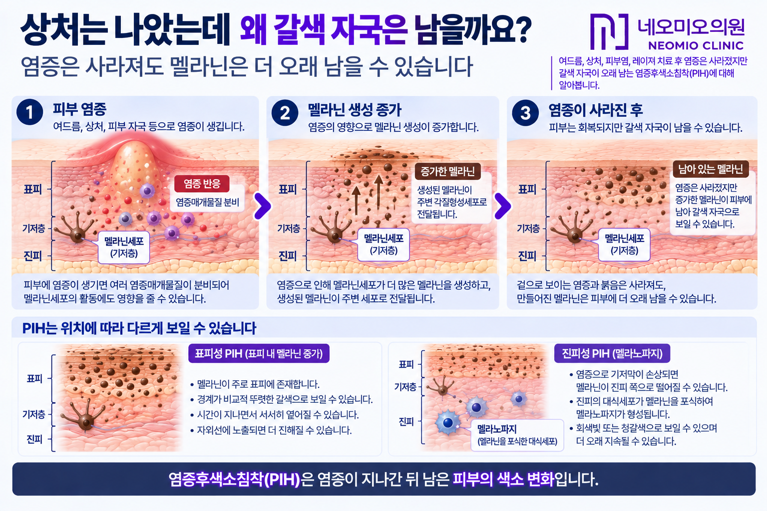 여드름이나 상처 등 피부 염증 후 멜라닌 생성이 증가해 염증이 사라진 뒤에도 갈색 자국으로 남는 염증후색소침착 PIH의 발생 과정을 설명한 이미지
