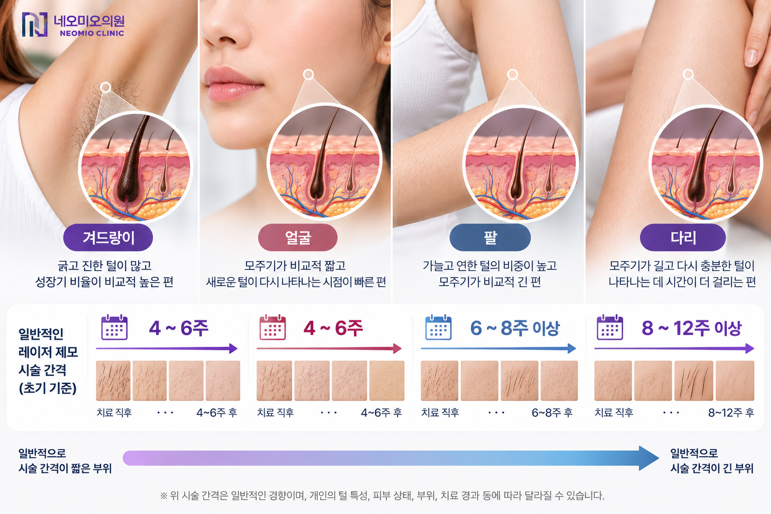 겨드랑이 팔 다리 등 신체 부위마다 털의 굵기와 색 및 성장주기가 달라 레이저 제모 반응에 차이가 생기는 원리를 설명하는 이미지