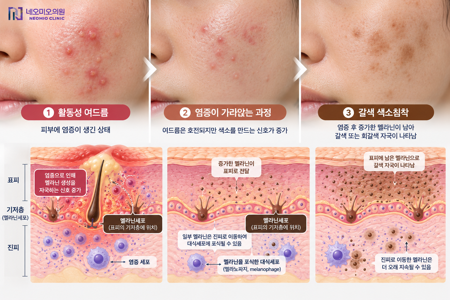 여드름 염증이 가라앉은 뒤 멜라닌이 남아 갈색 염증후색소침착으로 이어지는 과정을 설명하는 이미지