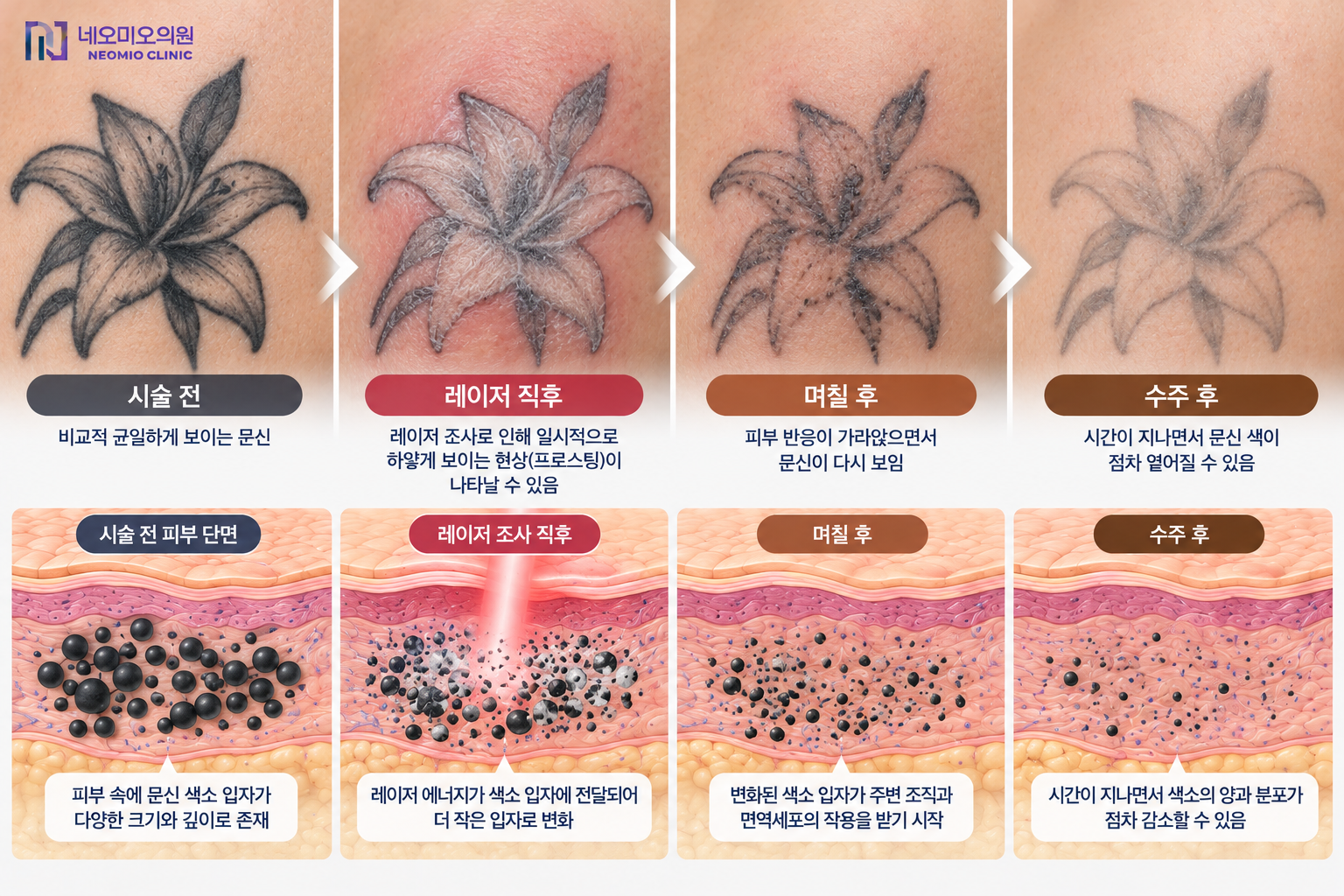 문신제거 레이저 조사 직후부터 수주가 지나면서 피부 속 문신 색소가 변화하고 문신이 점차 옅어지는 과정을 설명하는 이미지