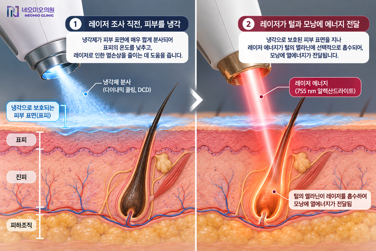 레이저 제모 직전 피부 표면을 냉각해 표피를 보호하면서 레이저 에너지가 털과 모낭에 전달되는 원리를 설명하는 이미지