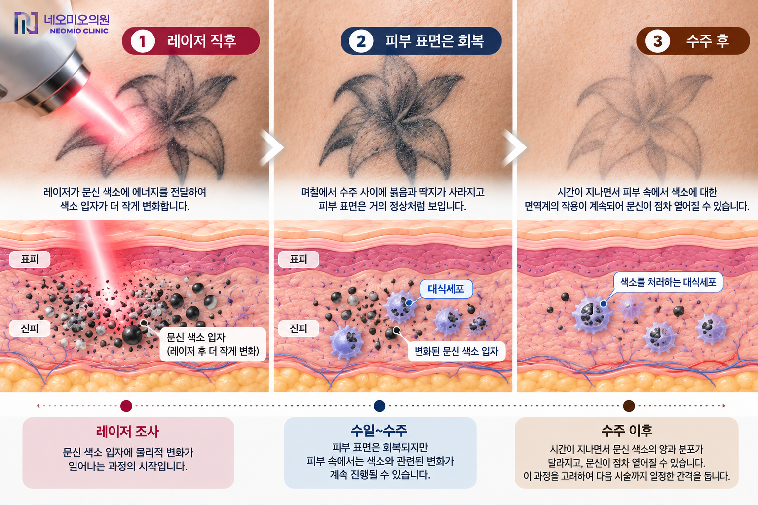 문신제거 레이저 후 피부 표면이 회복된 뒤에도 피부 속 문신 색소와 관련된 변화가 수주 동안 계속되어 치료 사이에 일정한 간격이 필요한 이유를 설명하는 이미지