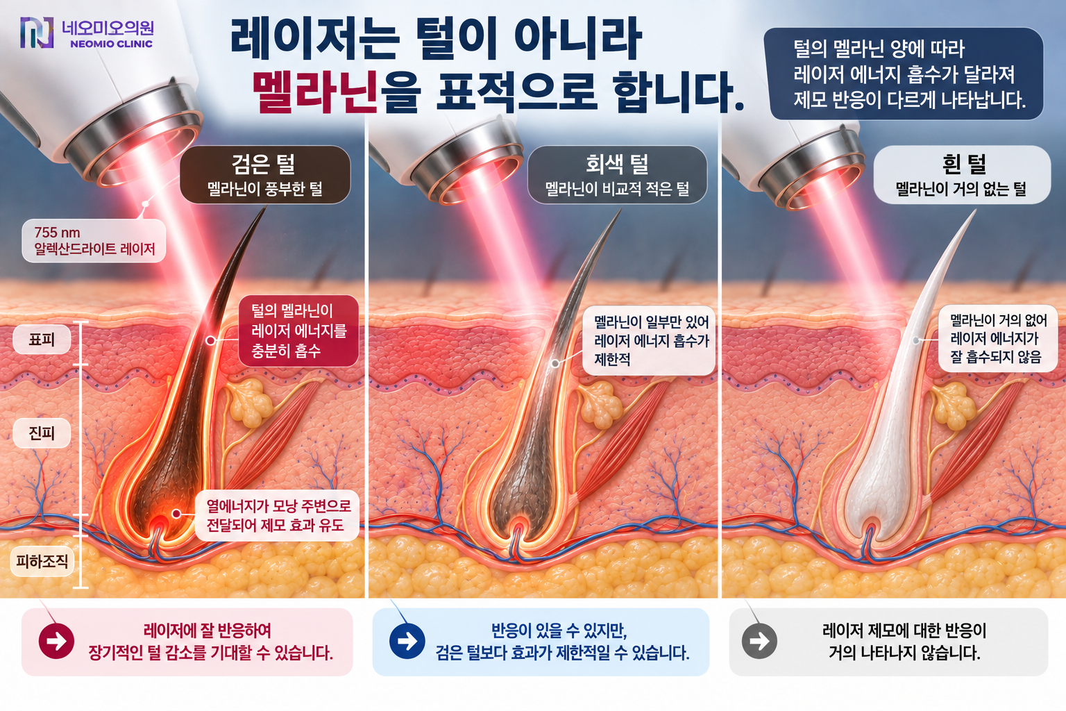 검은 털과 회색 털, 흰 털의 멜라닌 양에 따라 레이저 에너지 흡수와 레이저 제모 반응이 달라지는 원리를 설명하는 이미지