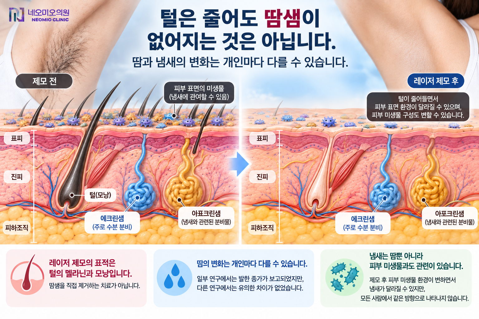 겨드랑이 레이저 제모 전후의 모낭과 땀샘 및 피부 미생물 환경을 비교해 제모 후 땀과 냄새가 다르게 느껴질 수 있는 이유를 설명하는 이미지