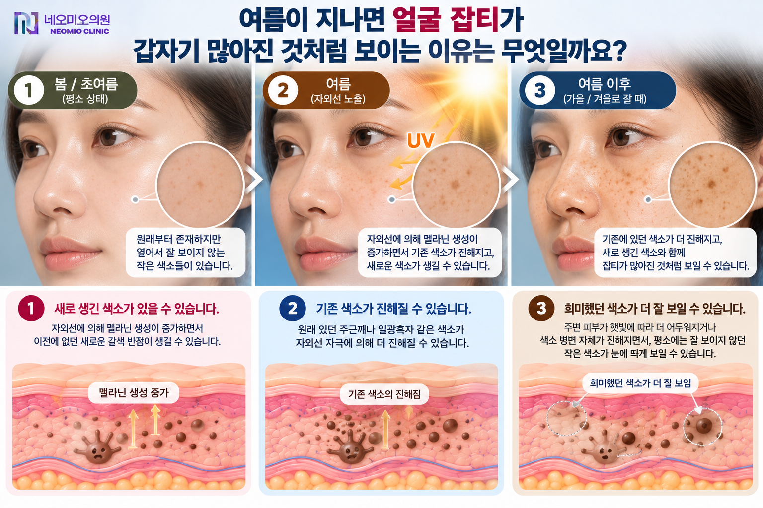 여름철 자외선 노출로 새로운 색소가 생기거나 기존의 주근깨와 갈색 반점이 진해져 얼굴 잡티가 갑자기 많아진 것처럼 보일 수 있는 이유를 설명한 이미지