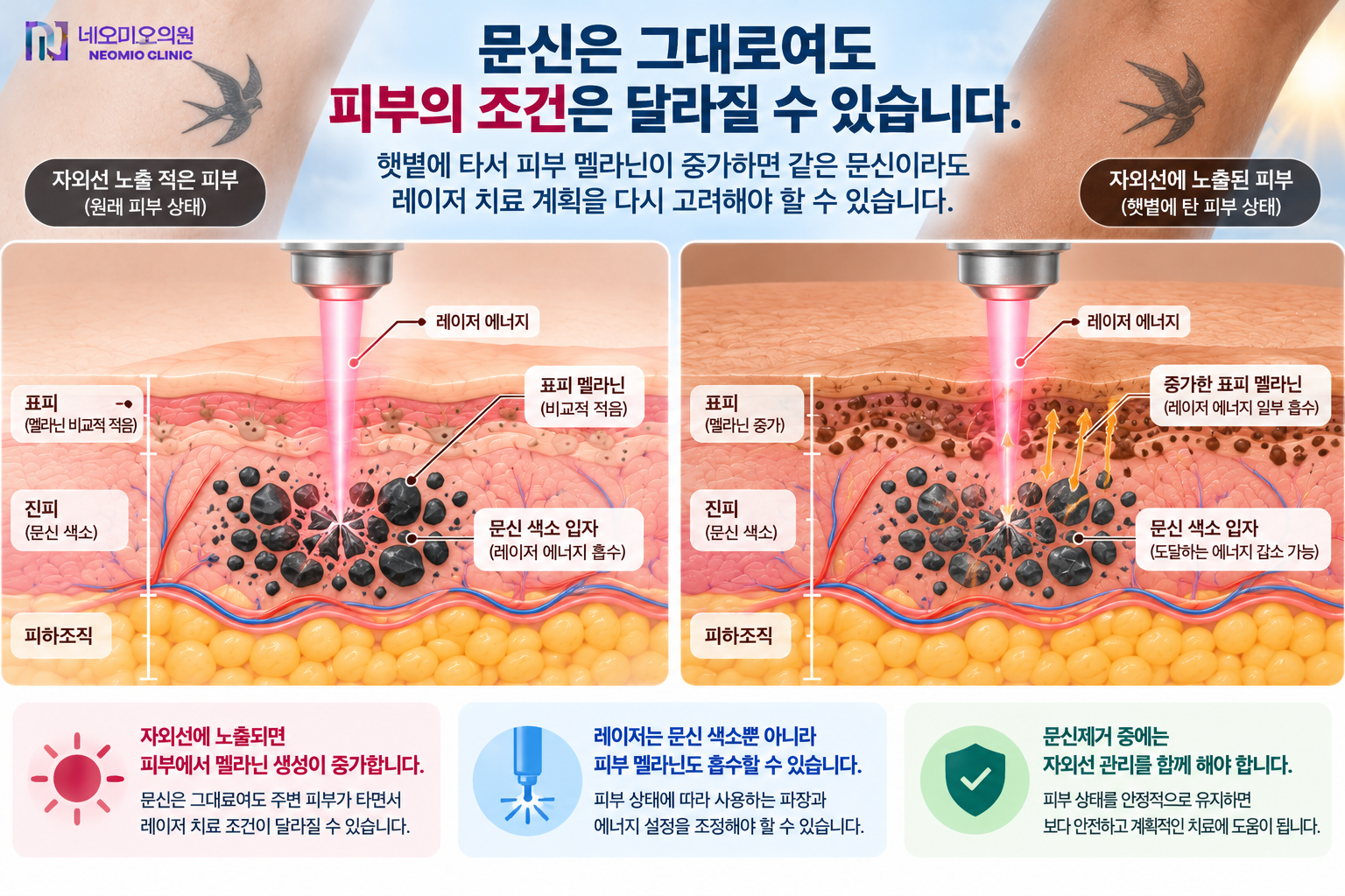 문신제거 중 자외선 노출로 피부 멜라닌이 증가하면 같은 문신이라도 레이저 에너지가 표피 멜라닌에도 흡수될 수 있어 치료 계획을 다시 고려해야 하는 이유를 설명하는 이미지