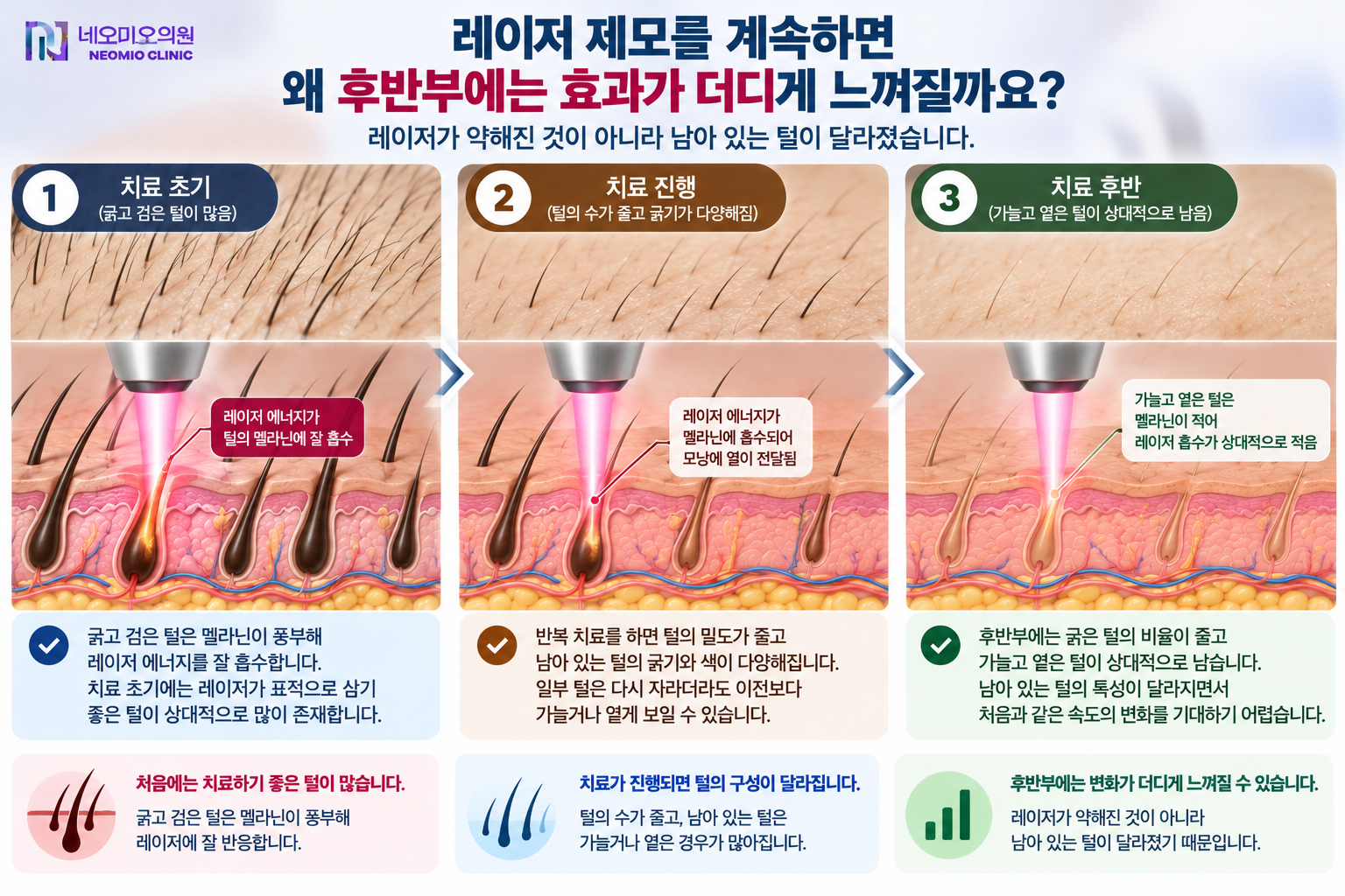 레이저 제모 초기의 굵고 검은 털이 치료를 거치며 감소하고 후반에는 가늘고 옅은 털이 상대적으로 남아 제모 효과가 더디게 느껴질 수 있는 이유를 설명하는 이미지