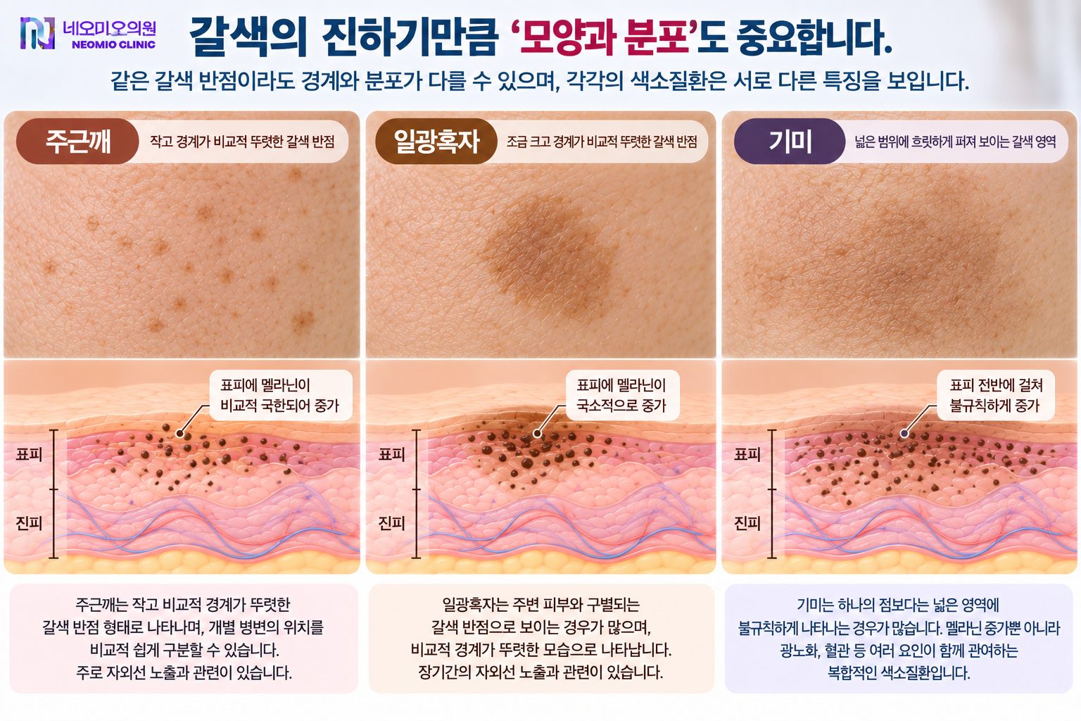 주근깨와 일광흑자처럼 비교적 경계가 뚜렷한 갈색 반점과 기미처럼 넓고 흐릿하게 분포하는 색소의 차이를 비교해 색소질환의 모양과 분포가 중요한 이유를 설명하는 이미지