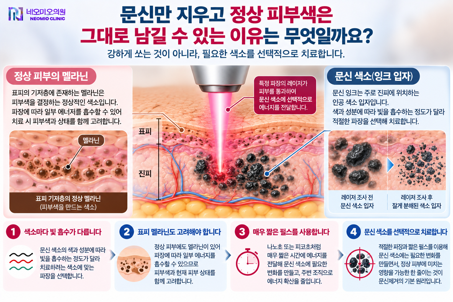 레이저 문신제거에서 표피의 정상 멜라닌과 진피의 문신 색소를 구분하고 적절한 파장과 짧은 펄스를 이용해 문신 색소에 선택적으로 에너지를 전달하는 원리를 설명하는 이미지