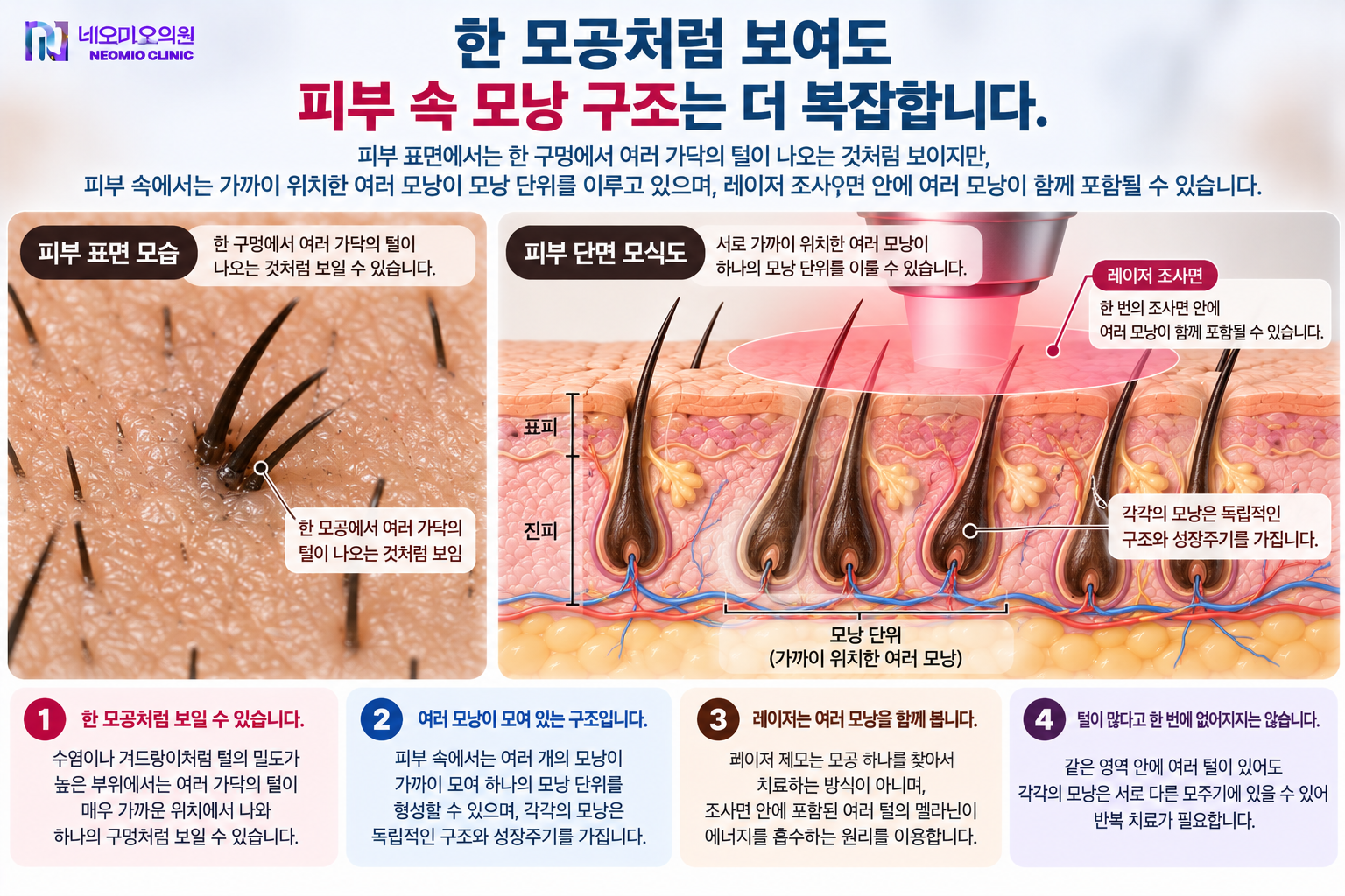 피부 표면에서는 한 모공에서 여러 가닥의 털이 나오는 것처럼 보이지만 피부 속에서는 가까이 위치한 여러 모낭이 모낭 단위를 이루며 레이저 조사면 안에 여러 털이 함께 포함되는 구조