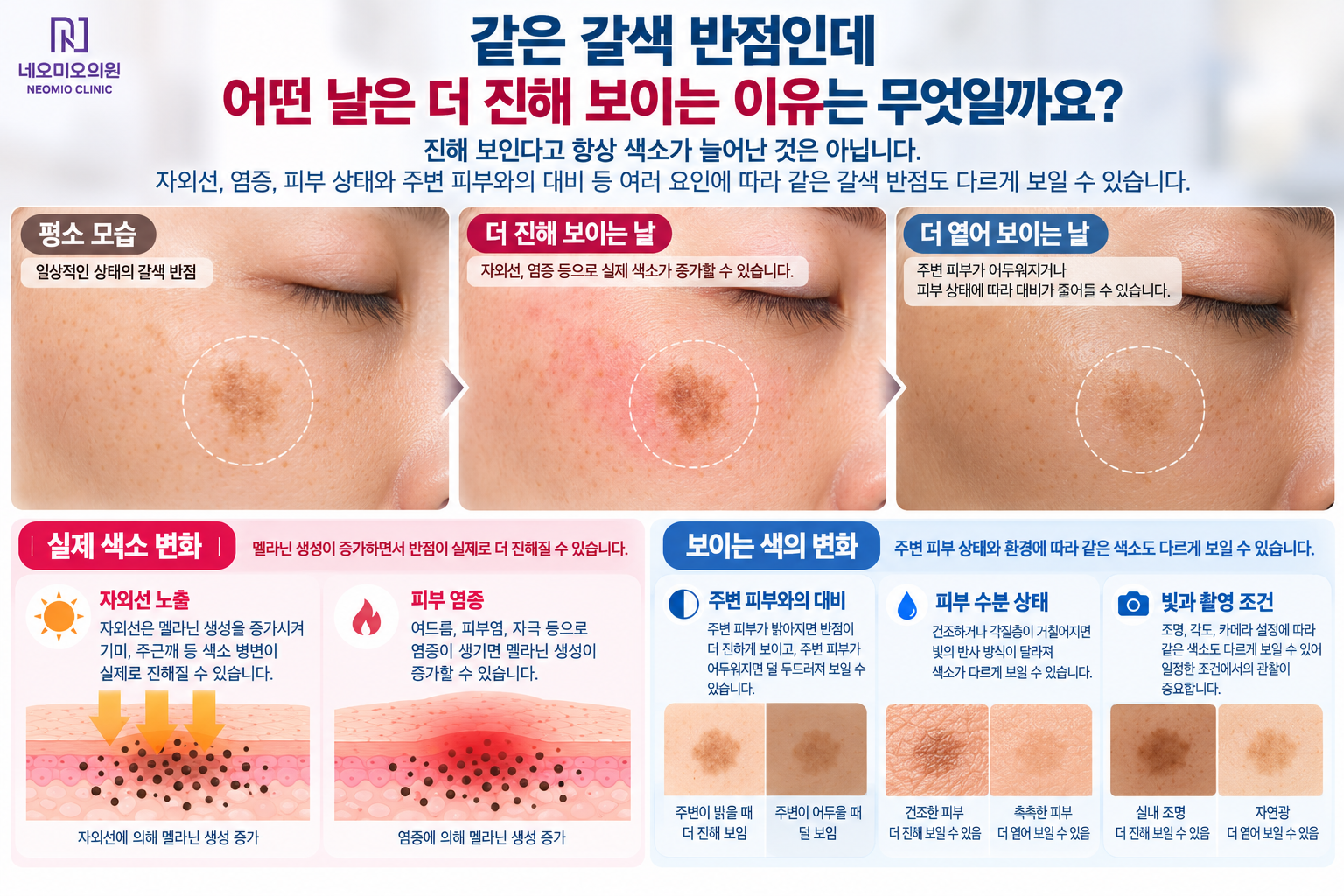 같은 갈색 반점도 실제 멜라닌의 변화뿐 아니라 자외선과 염증, 주변 피부와의 대비 및 피부 표면 상태에 따라 더 진하거나 옅게 보일 수 있는 이유를 설명하는 이미지