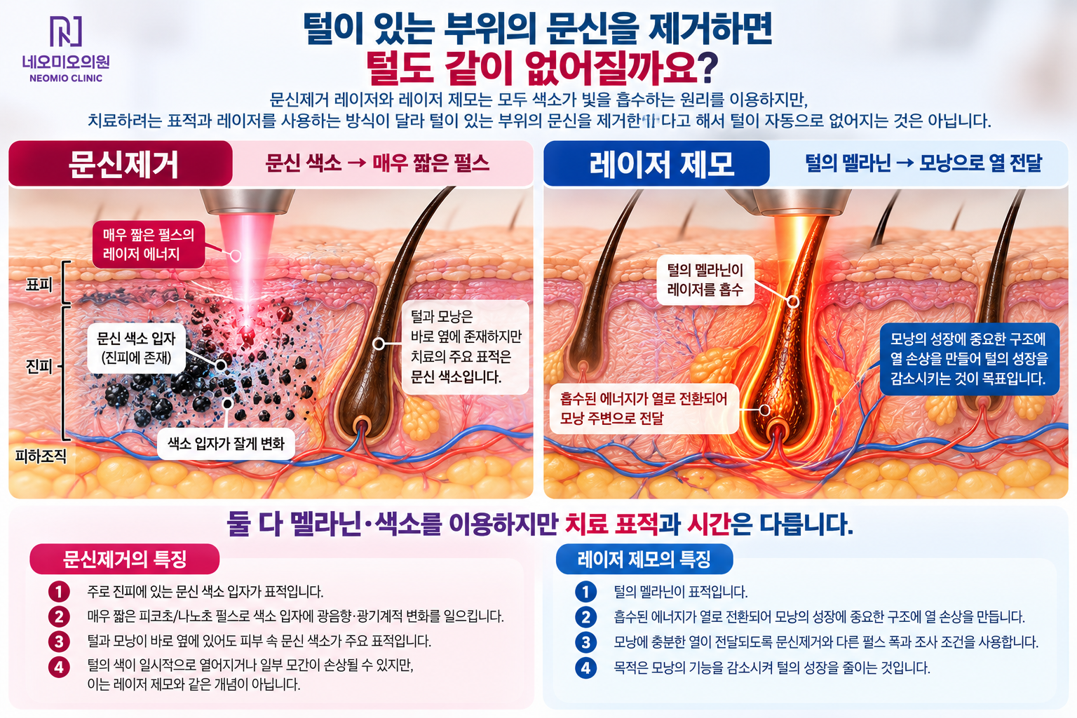 털이 있는 문신 부위에서 문신제거 레이저는 진피의 문신 색소 입자를 표적으로 하고 레이저 제모는 털의 멜라닌을 통해 모낭에 열을 전달하는 차이를 비교한 이미지