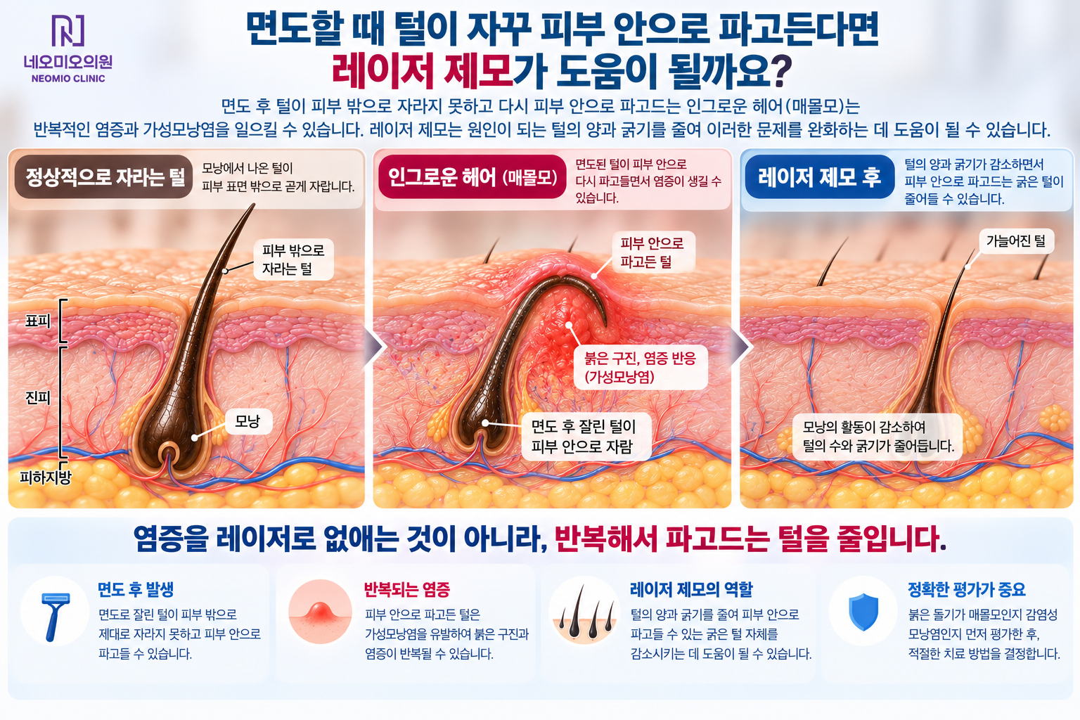 면도 후 굵은 털이 피부 안으로 다시 파고들어 인그로운 헤어와 가성모낭염을 일으키는 과정과 레이저 제모로 털의 양과 굵기가 감소하면서 반복되는 매몰모를 줄이는 원리를 설명한 이미지