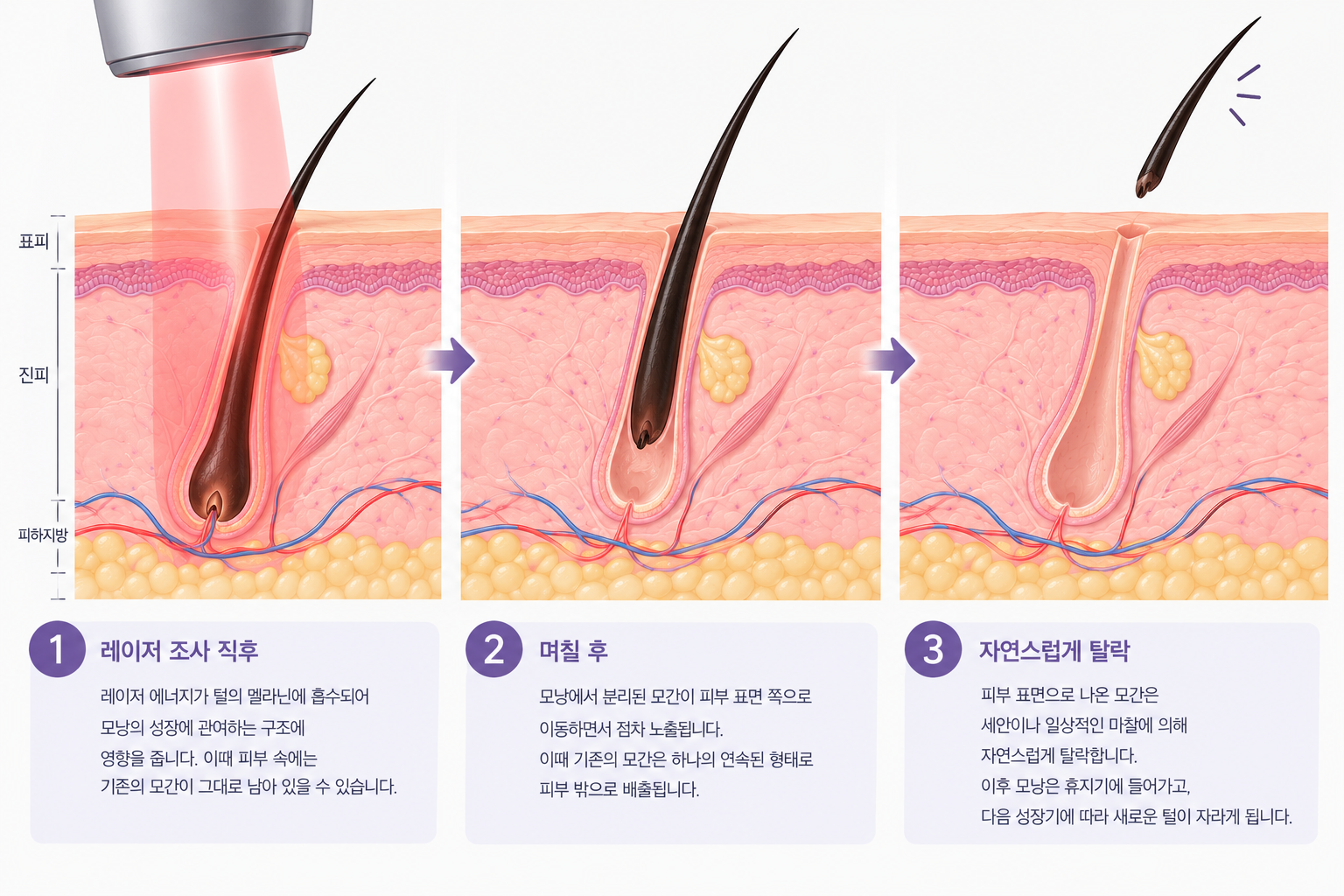 레이저 제모 후 모낭 안에 남아 있던 털이 피부 표면으로 이동한 뒤 자연스럽게 탈락하는 과정을 보여주는 피부 단면 의료 일러스트