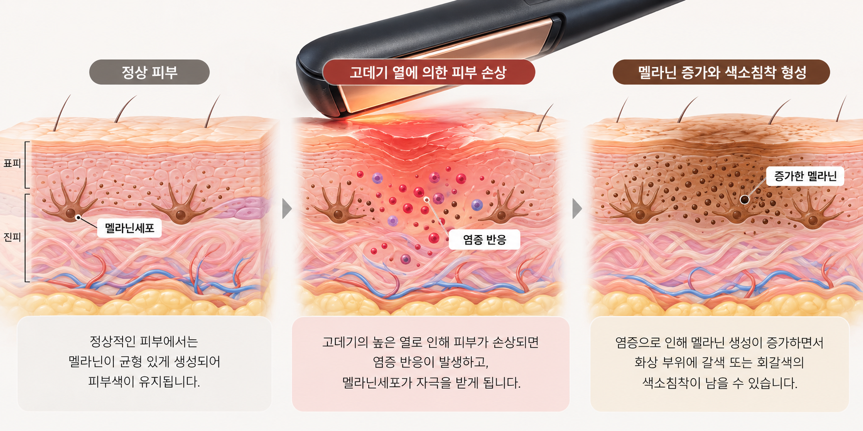 고데기 화상 후 피부 염증으로 멜라닌 생성이 증가하여 갈색 색소침착이 발생하는 과정을 보여주는 피부 단면 의학 일러스트 - 네오미오의원