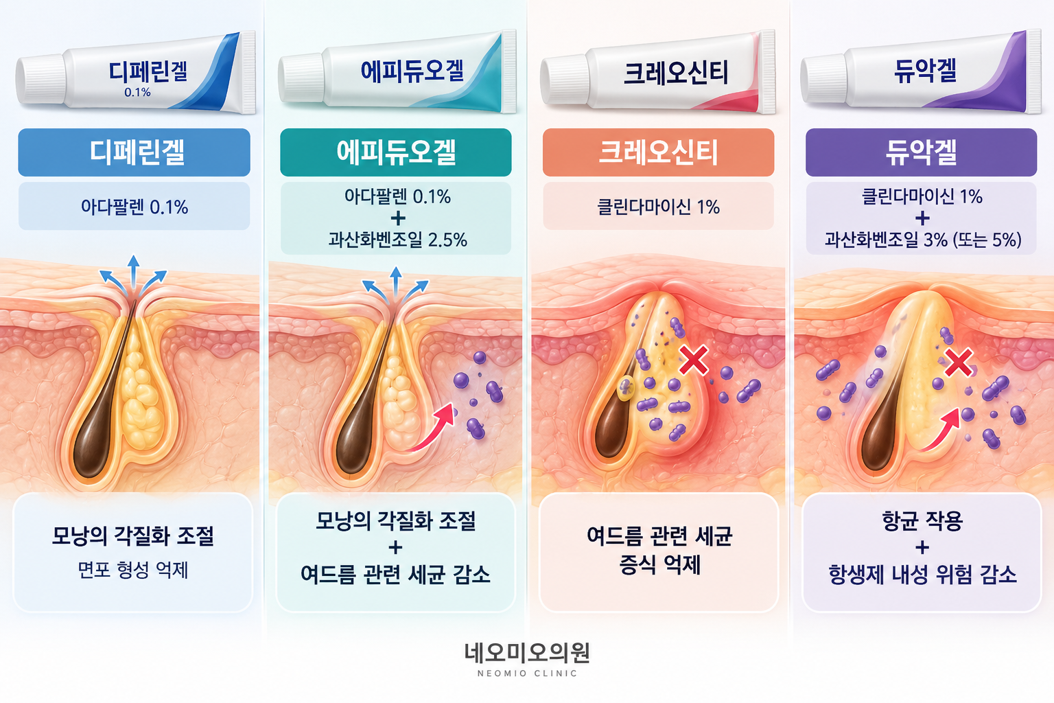 디페린겔, 에피듀오겔, 크레오신티, 듀악겔의 주요 성분과 여드름 치료 작용 원리를 비교한 그림. 아다팔렌의 모낭 각질화 조절, 과산화벤조일의 항균 작용, 클린다마이신의 세균 증식