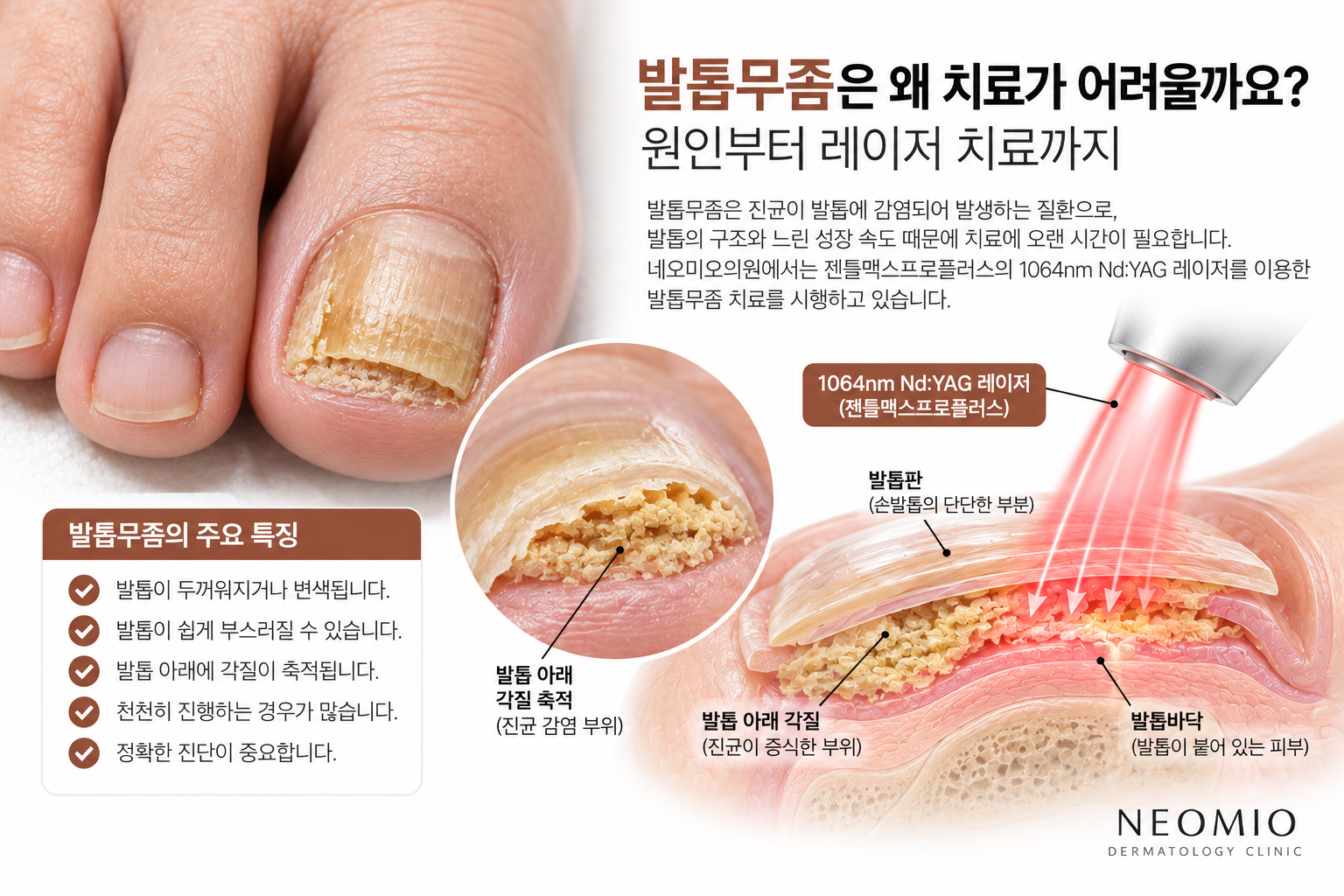 발톱무좀의 발생 구조와 발톱 아래 진균 감염 부위, 1064nm Nd:YAG 레이저 에너지의 전달 원리를 설명하는 의학 일러스트. 네오미오의원의 젠틀맥스프로플러스 발톱무좀 레이저