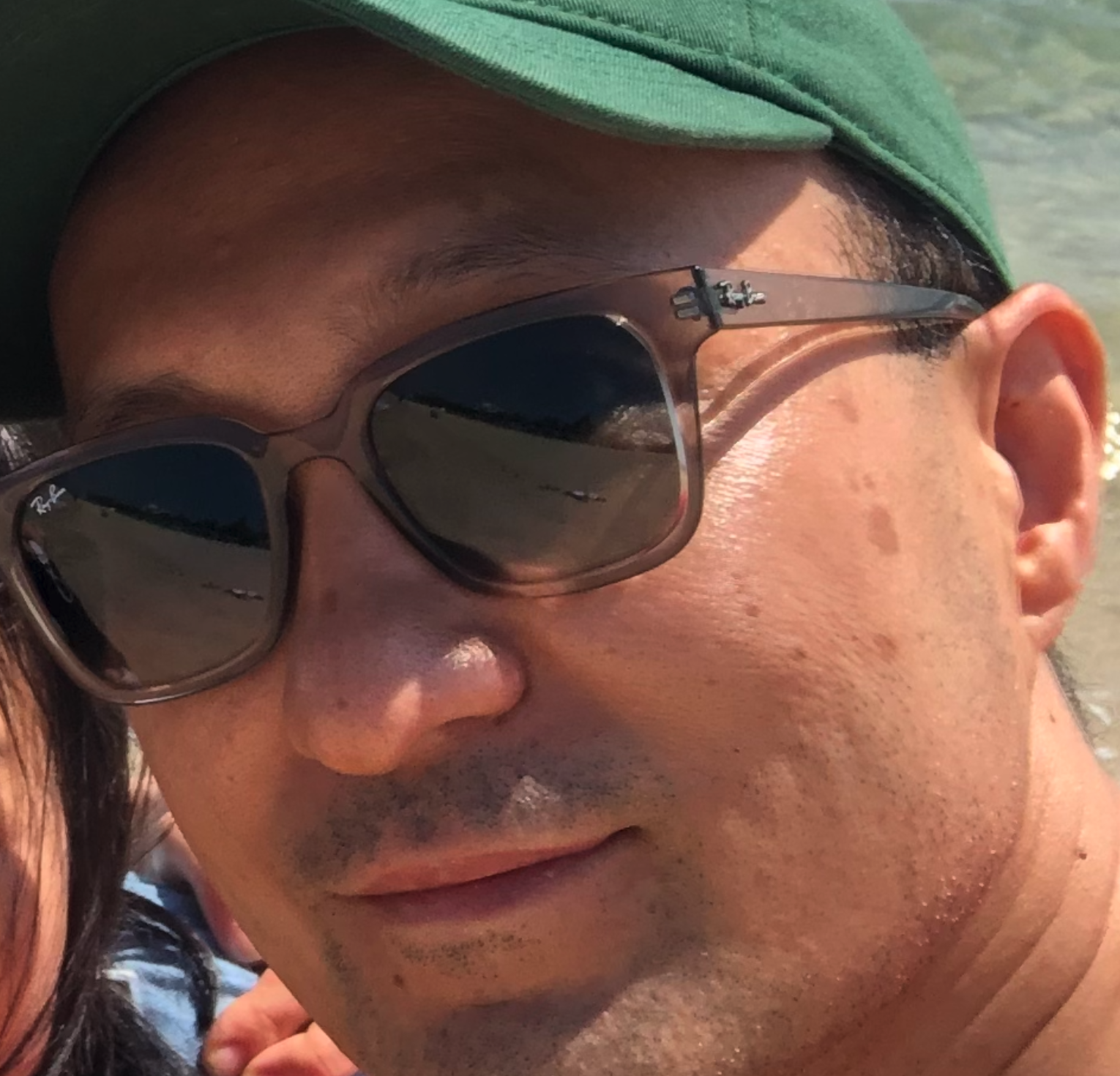 2020년 6월 촬영한 네오미오의원 박기호 원장의 실제 얼굴 사진. 오른쪽 광대와 관자 부위에 흑자가 관찰되며, 이후 피코웨이 레이저를 이용해 직접 시술한 경험을 소개하는 칼럼의