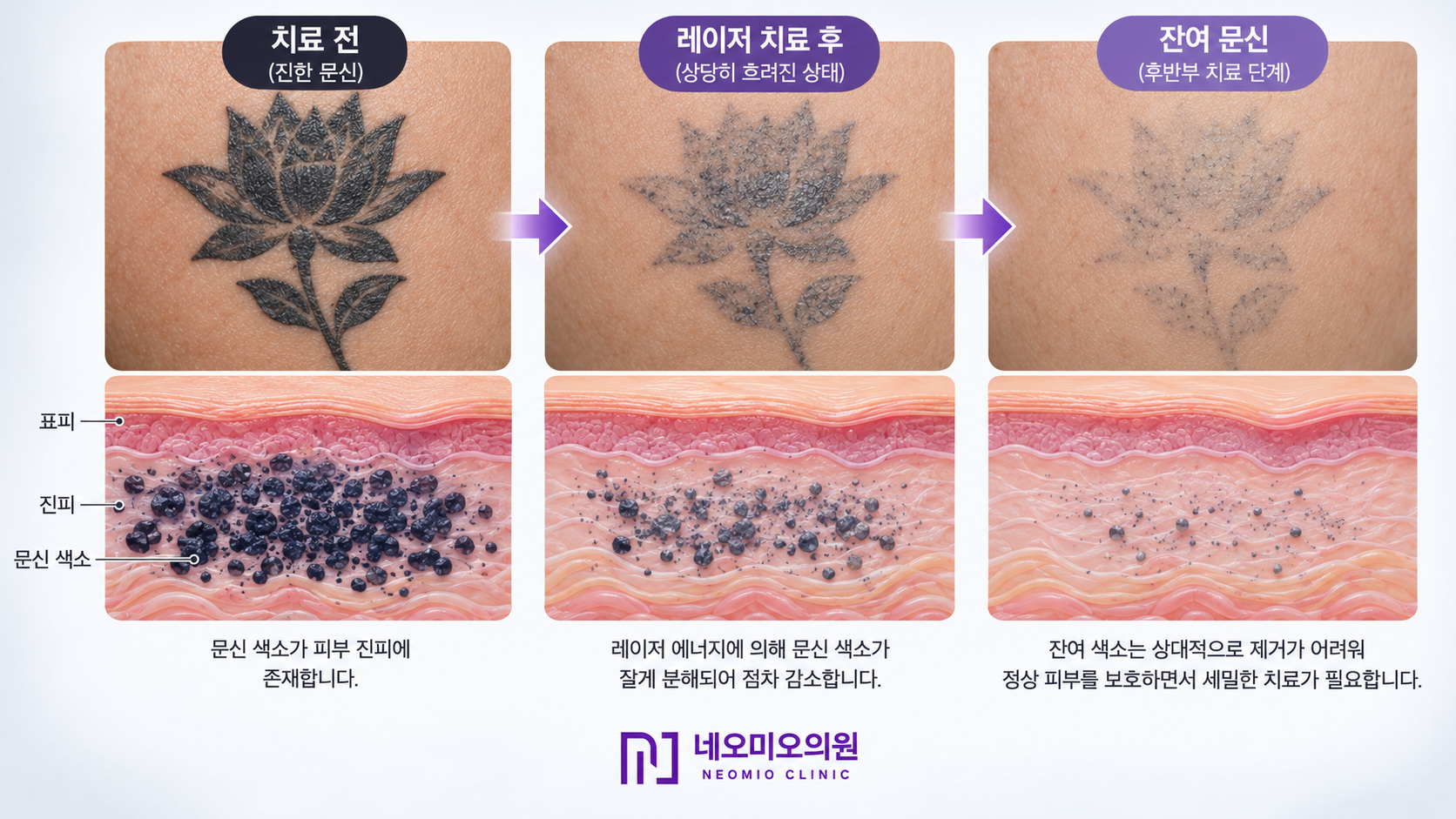 흐려진 문신의 잔여 색소와 문신제거 후반부의 치료 과정을 설명하는 피부 단면 도식. 진한 문신부터 레이저 치료 후 남은 색소까지의 변화를 비교한 네오미오의원 문신제거 칼럼 이미지.
