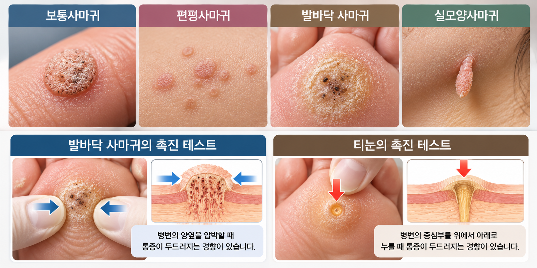 사마귀는 발생 부위와 형태에 따라 보통사마귀, 편평사마귀, 발바닥 사마귀, 실모양사마귀 등으로 구분합니다. 각 유형은 피부 표면의 형태와 발생 위치에 차이가 있으며, 치료 방법도